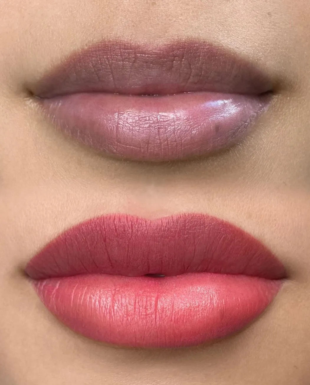 Touraine Filvert | Eating After Lip Neutralization Eating After Lip Neutralization