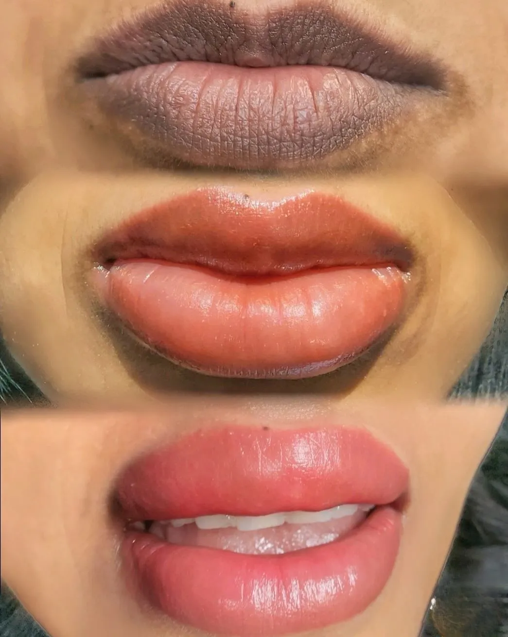 Touraine Filvert | Eating After Lip Neutralization Foods to Eat