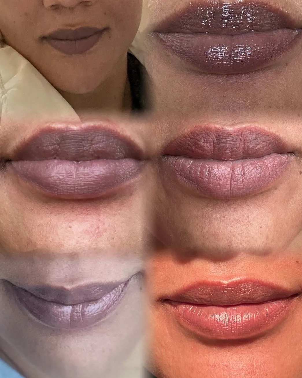 Touraine Filvert | Eating After Lip Neutralization Further Considerations
