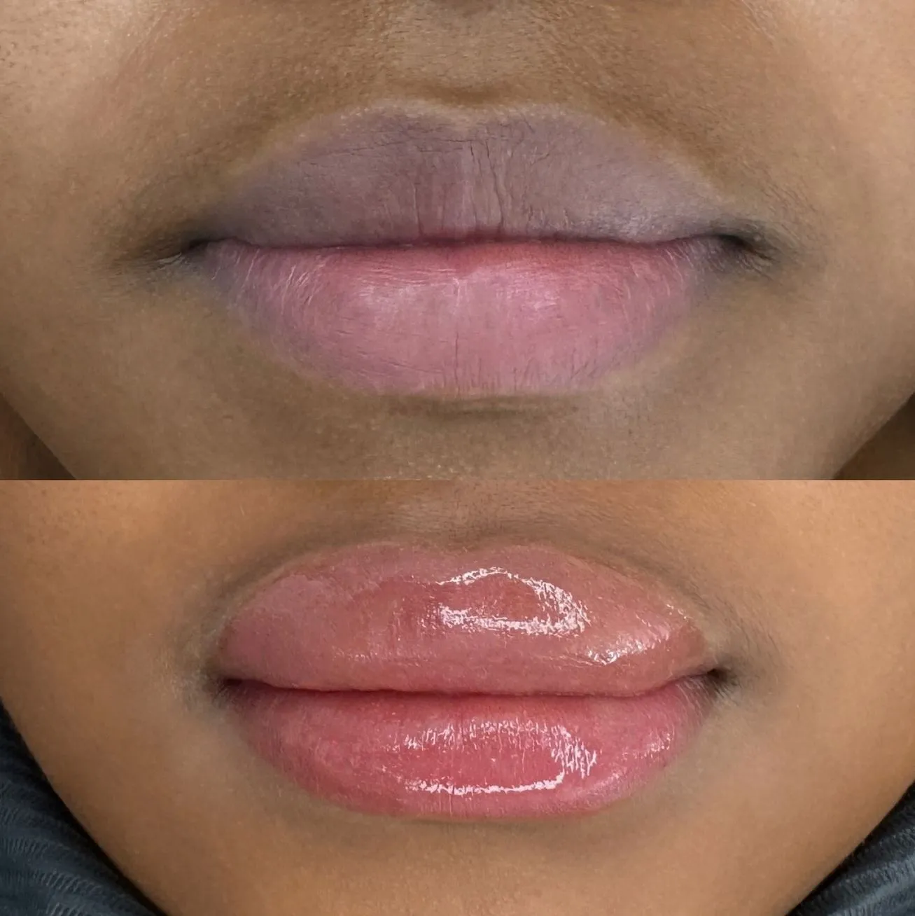 Touraine Filvert | Eating After Lip Neutralization Lip neutralization